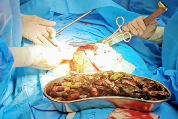 خروج ۹۰ بسته مواد مخدر از معده و روده بیماری در کرج&nbsp;